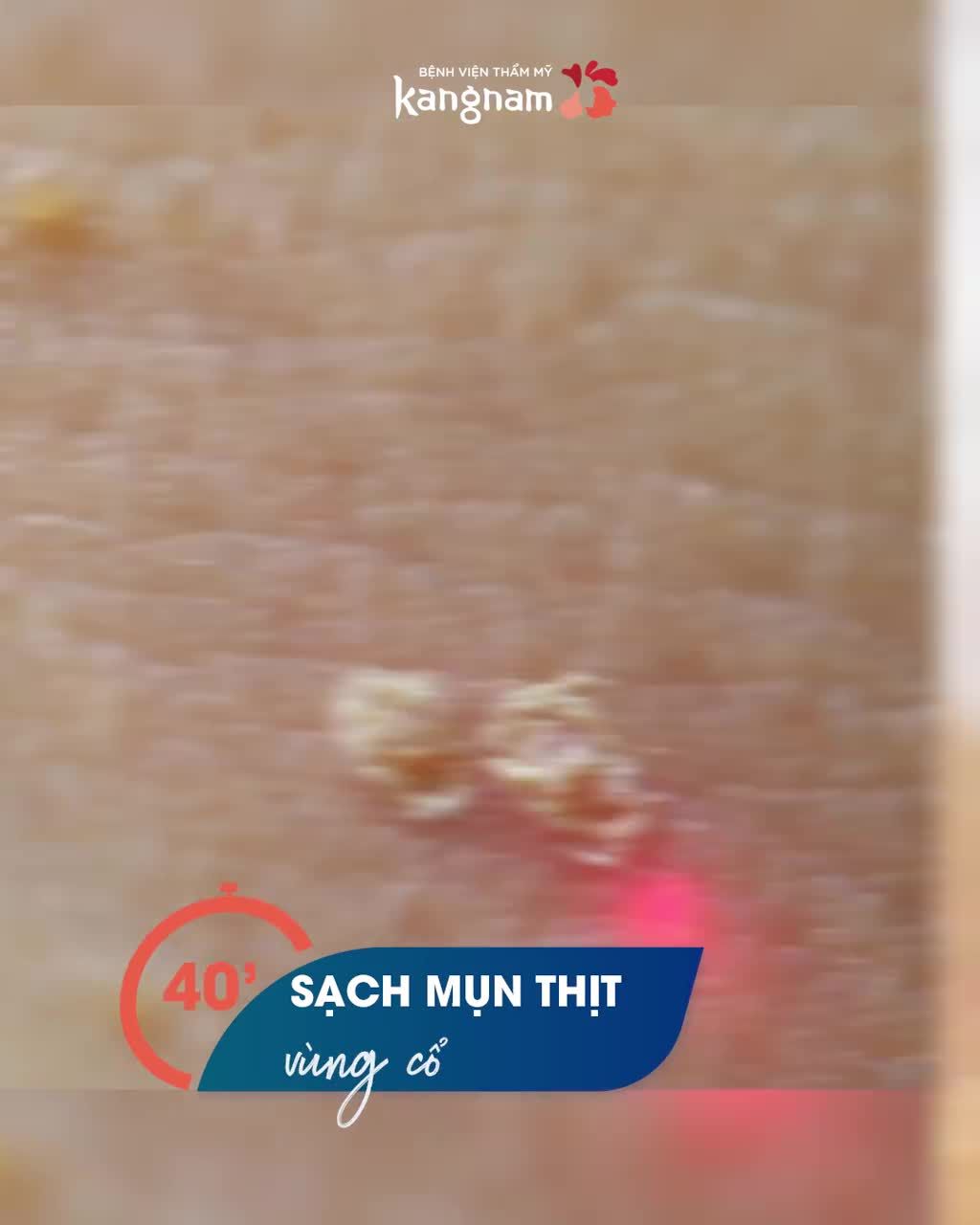 MỤN THỊT VÙNG NÀO TRỊ DỨT ĐIỂM VÙNG ĐẤY