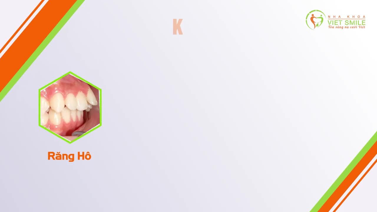 5 lý do để bạn an tâm lựa chọn niềng răng Viet Smile