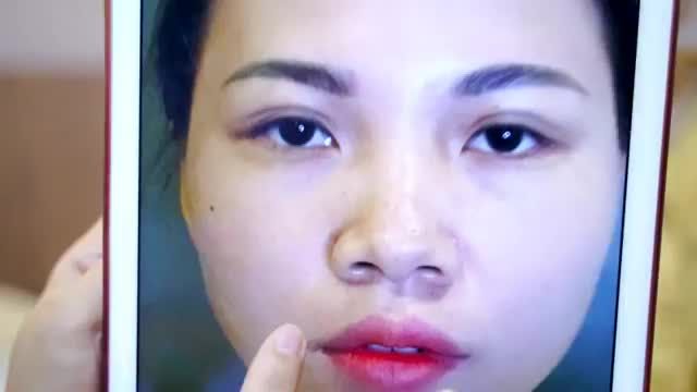 GIẢI CỨU ca mí lỗi hỏng thứ "N" cho em gái nhấn mí hỏng ở spa không uy tín - Mời quý khách hàng cùng theo dõi