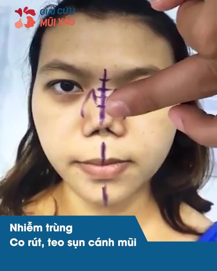 GIẢI CỨU MŨI XẤU - Sửa đúng chỗ - Kết quả tối ưu  Bác sĩ chuyên khoa sẵn sàng tư vấn cho từng chị em.