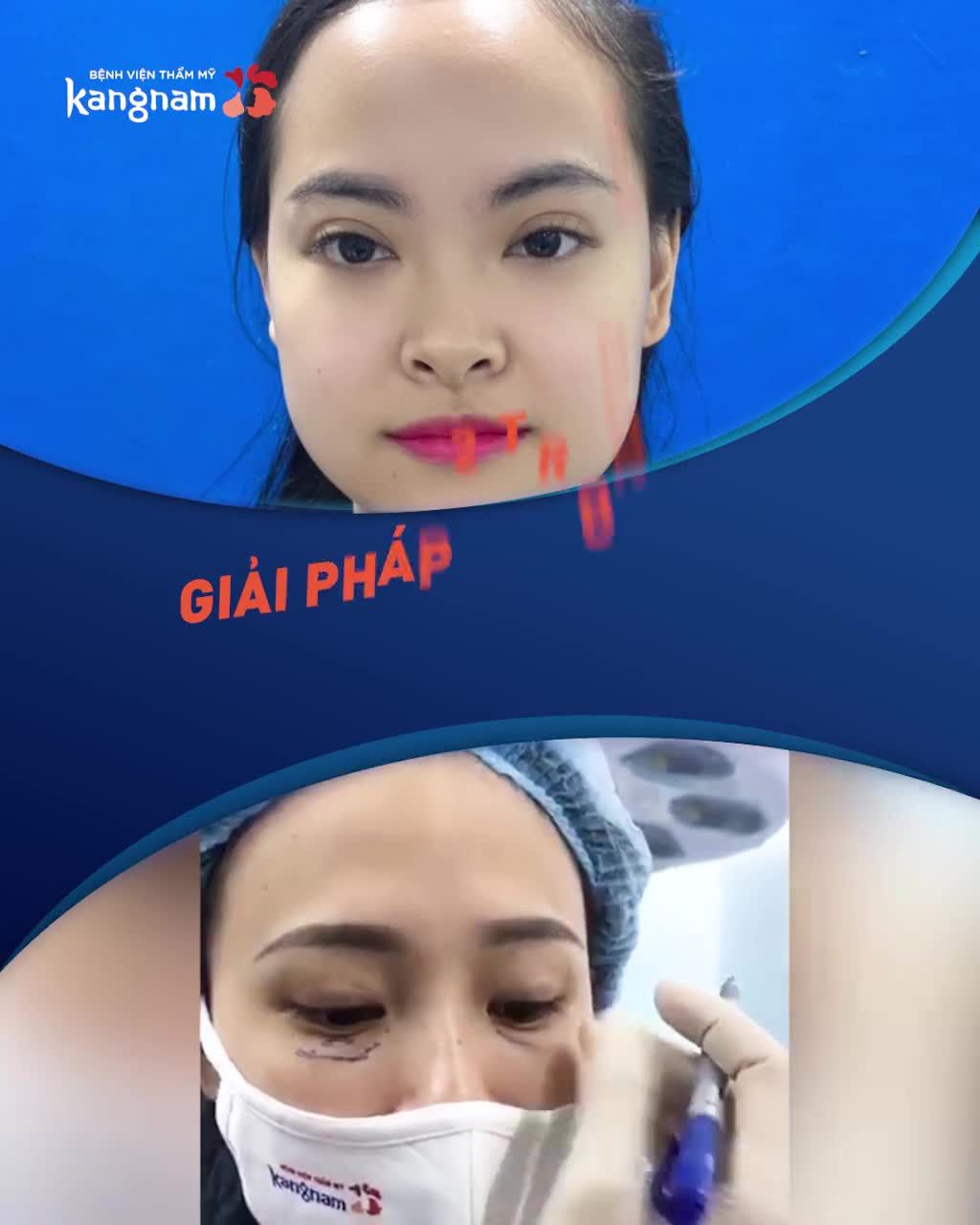 Mắt LÃO HÓA NẶNG: Bọng Mỡ lớn - Mí dưới Sa Trễ