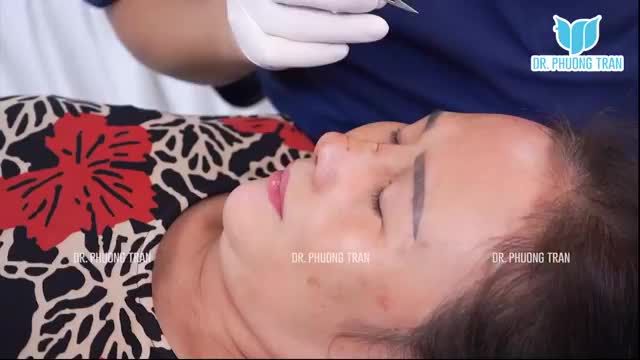BÁC SĨ TRỰC TIẾP TÁI KHÁM CHO CHỊ KHÁCH SAU 8 NGÀY NÂNG MŨI SỤN SƯỜN TOÀN PHẦN