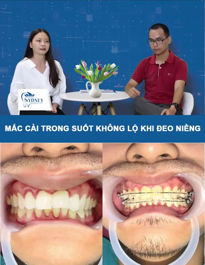 CẢI THIỆN TÌNH TRẠNG RĂNG HÔ VỚI MẮC CÀI PHA LÊ CHỈ TRONG 14 THÁNG
