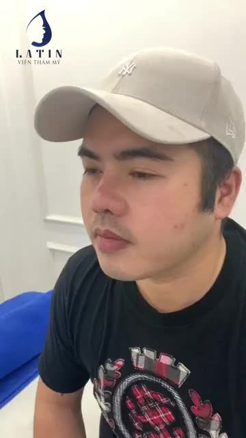 KH nam nâng mũi cấu trúc megaderm