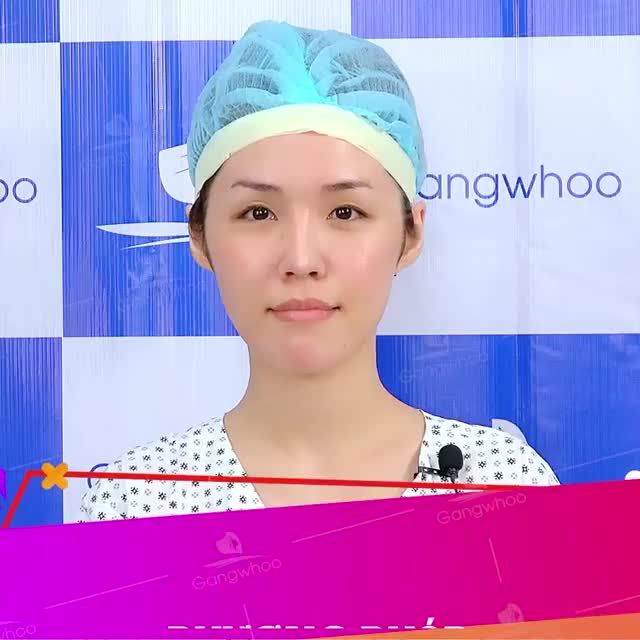 KHẮC PHỤC MŨI ĐÃ SỬA 7 NĂM BỊ TỤT SÓNG, LỘ SỤN, BÓNG ĐỎ ĐẦU MŨI