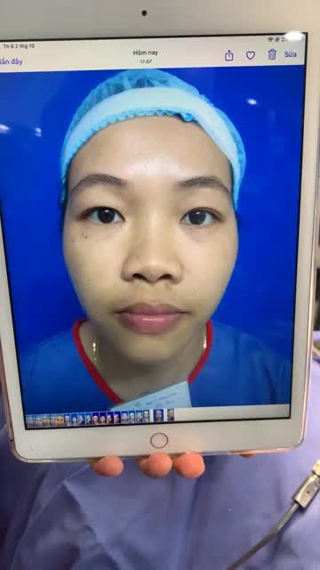 Khách hàng "lột xác" 360 độ sau khi NÂNG MŨI CẤU TRÚC 4D