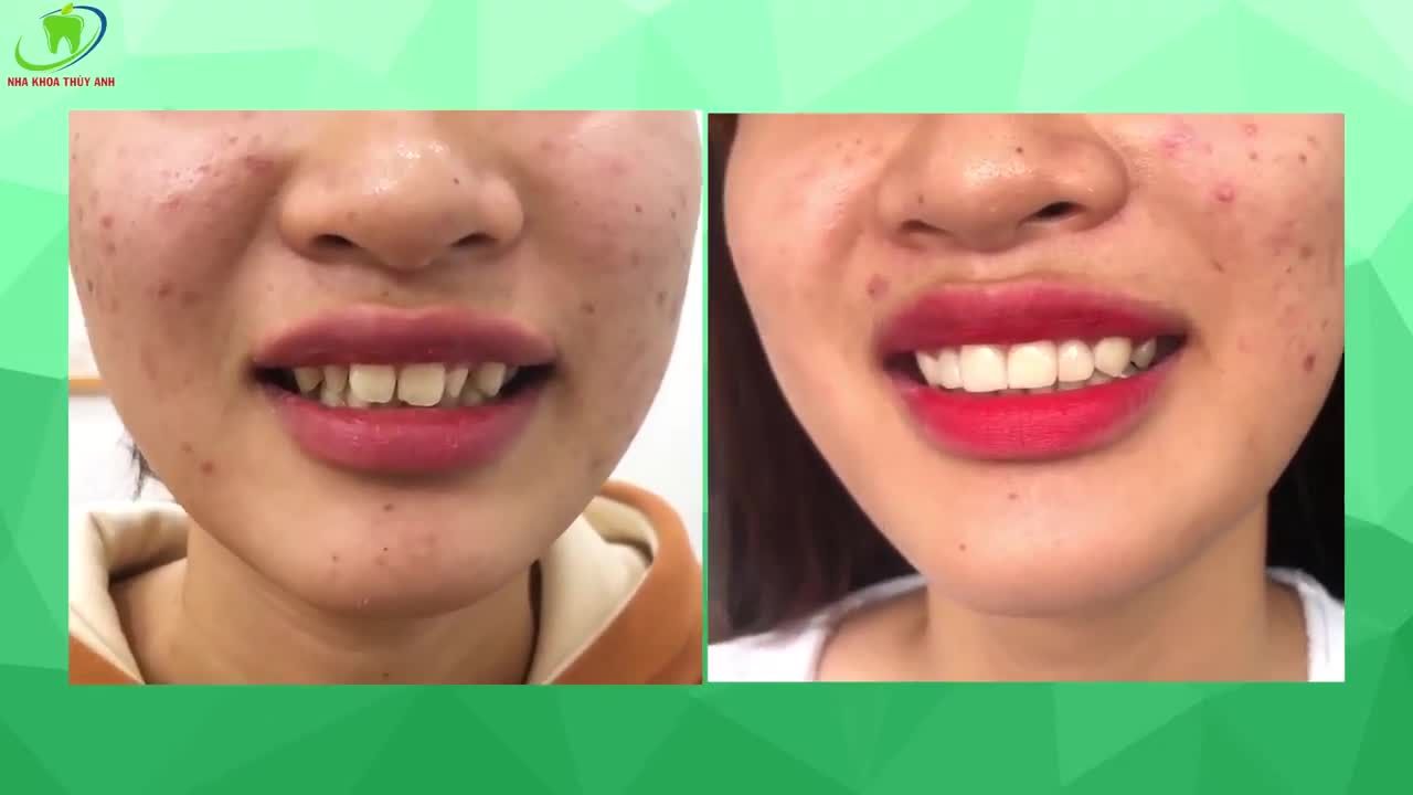 RĂNG CÓ ĐẸP THÌ CƯỜI MỚI TỰ TIN