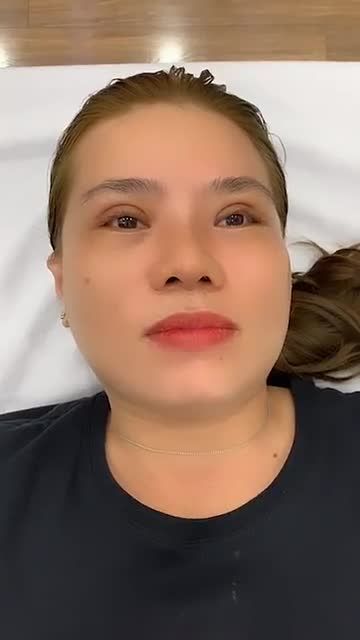 Tái khám dáng mũi + Nếp mí sau 10 ngày cho khách Việt kiều Philippin