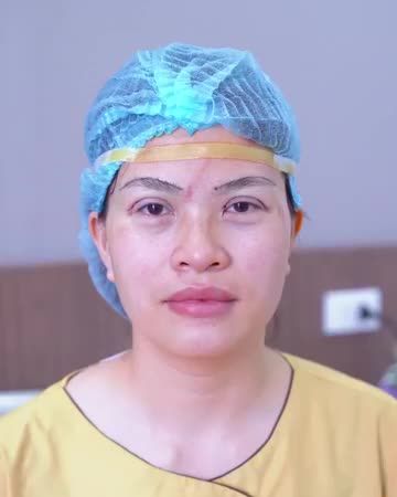 Mắt sụp mí già nua xử lý như thế nào để giúp khách hàng có đôi mắt rạng ngời, tươi trẻ? Mời khách hàng cùng theo dõi.!