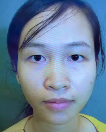 Người thật việc thật - Mời quý khách hàng cùng chiêm ngưỡng kết quả Cắt mí vừa thực hiện xong rất ít sưng/ không đau/ nếp mí tròn đều nhẹ nhàng như mong đợi