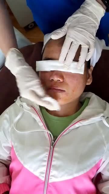 Da mụn viêm lâu năm bạn chán người chê Chọn ngay giải pháp trị mụn De Acne tại Kangnam