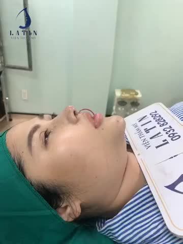MŨI LỖI SỬA LẠI SẼ THẾ NÀO?