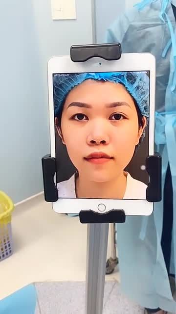 Nâng mũi cấu trúc mới làm xong