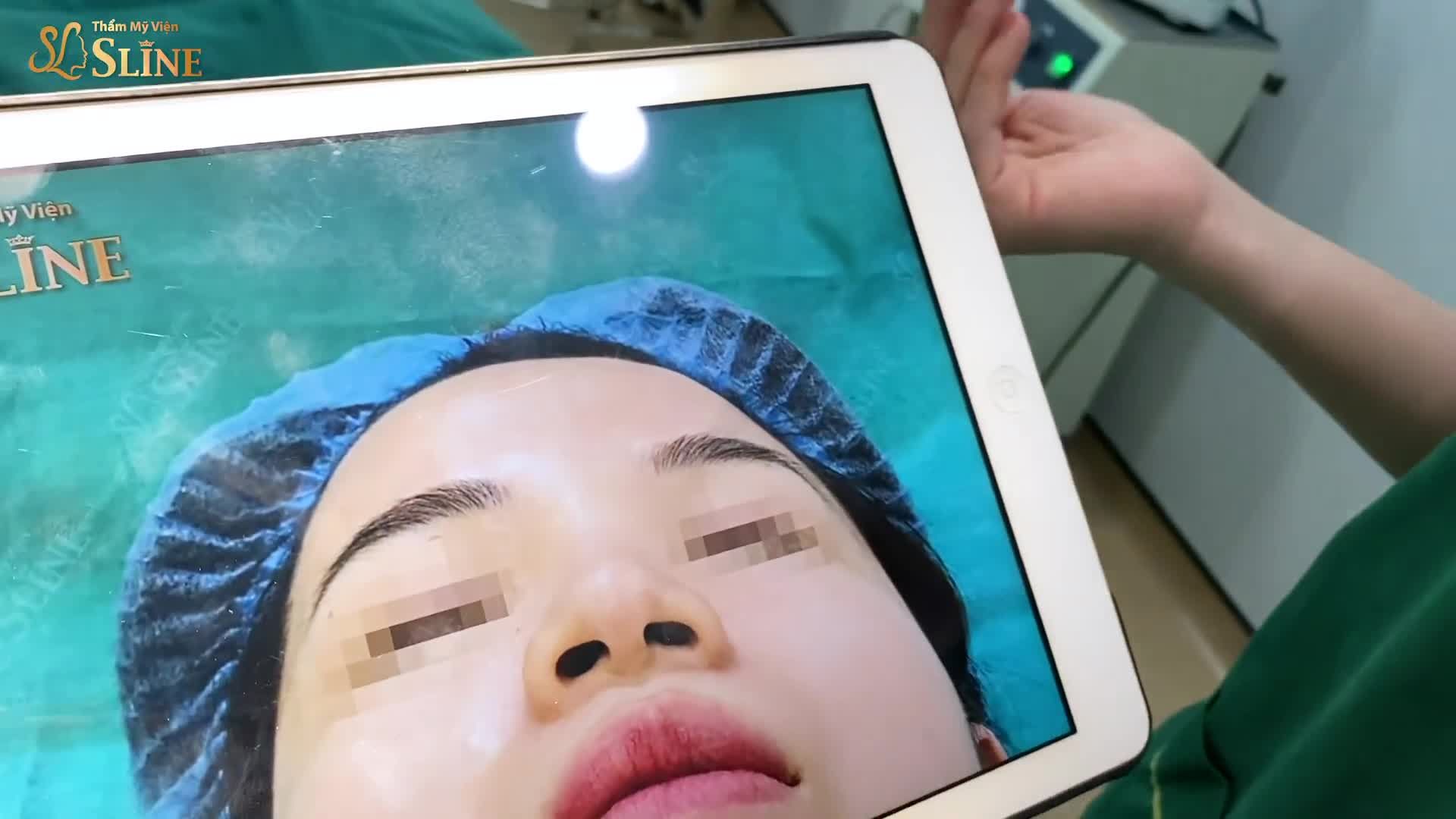 TRẺ HÓA VÙNG TRÁN
