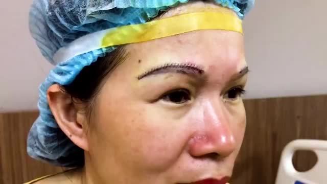 Treo cung mày giải pháp vàng giúp chị em phụ nữ thoát khỏi tình trạng da chùng sụp mí già nua, u buồn, che khuất tầm nhiền...