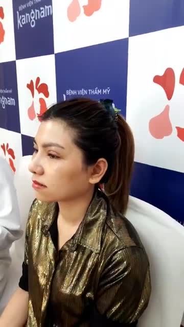 KHÁCH HÀNG SỬ DỤNG DỊCH VỤ NÂNG MŨI SLINE 4D+ CHỈNH XƯƠNG + CẮT CÁNH MŨI SAU 10 NGÀY CẮT CHỈ