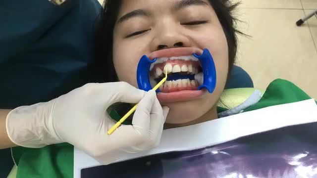 Ca gắn mắc cài ngày chủ nhật tại Nha Khoa Thuỳ Anh.
