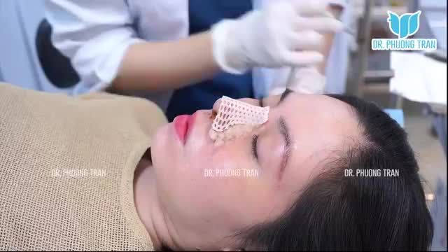 CẬN CẢNH MŨI SỤN SƯỜN TOÀN PHẦN SAU 7 NGÀY PHẪU THUẬT