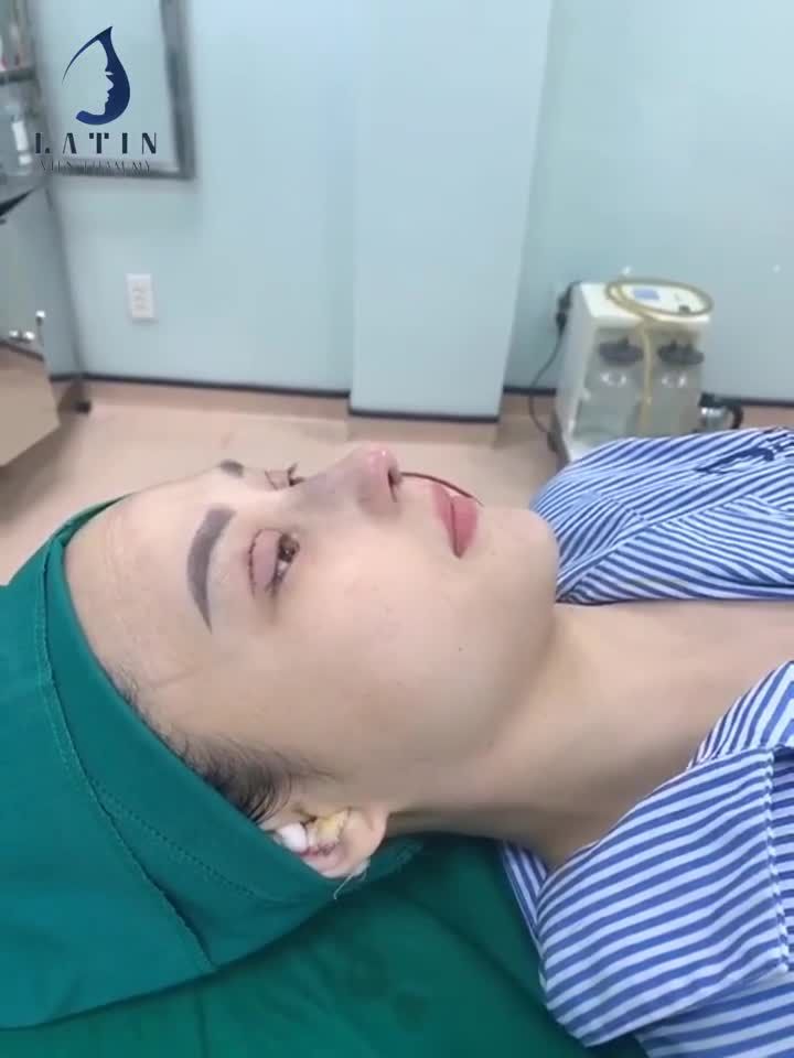 COMBO NÂNG MŨI TÁI CẤU TRÚC SỤN SURGIFORM VÀ CẮT MÍ 4D