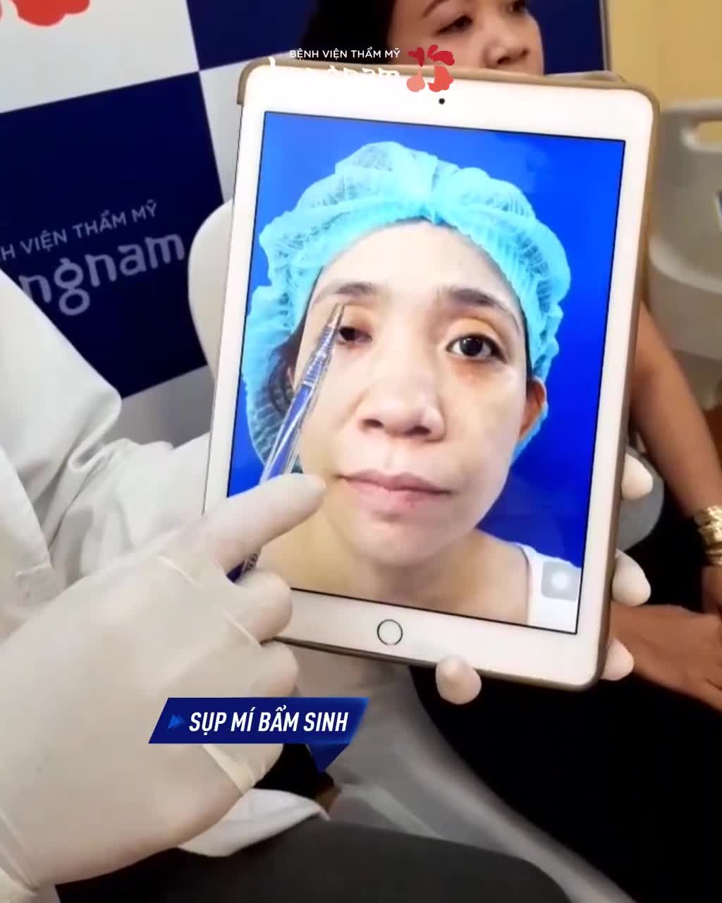 Hơn 30 năm - Không mở được MẮT PHẢI