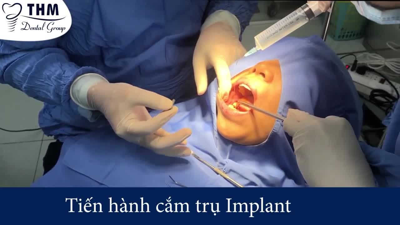 01 CA IMPLANT ĐƠN LẺ TẠI NHA KHOA THẾ HỆ MỚI