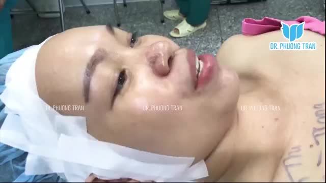 CẬN CẢNH TOÀN BỘ QUÁ TRÌNH NÂNG MŨI CẤU TRÚC SỤN SƯỜN TOÀN PHẦN