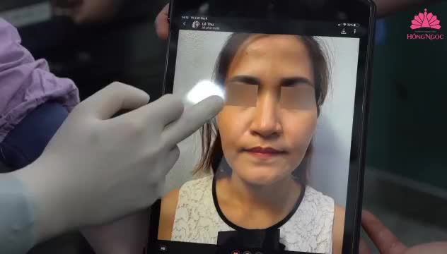 CẤY MỠ MẶT BABY FACE - ĐẸP NGAY TỨC THÌ