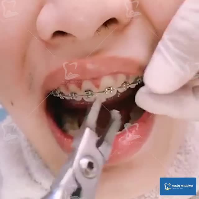 HÀNH TRÌNH TÌM KIẾM NỤ CƯỜI ĐẸP ĐÃ TỚI HỒI KẾT – NHA KHOA NGÂN PHƯỢNG CHÚC MỪNG KHÁCH HÀNG NIỀNG RĂNG THÀNH CÔNG