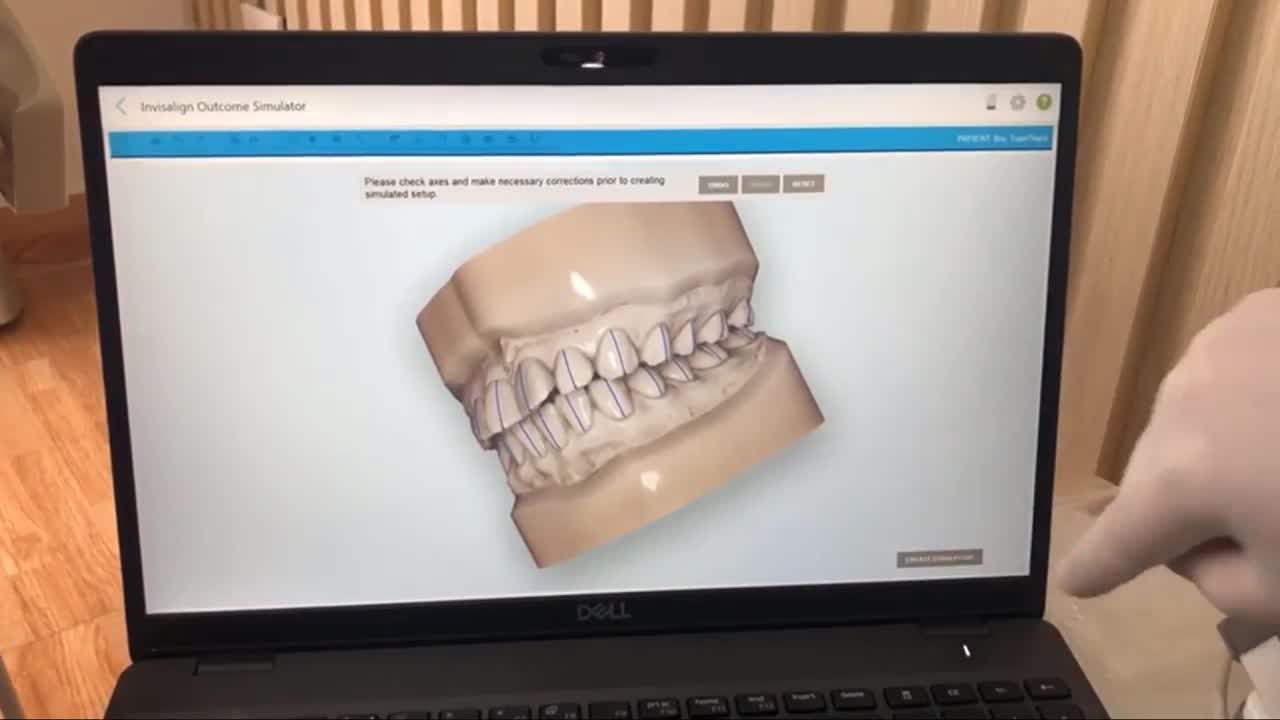 Tại sao bạn nên niềng răng bằng máng trong suốt Invisalign?