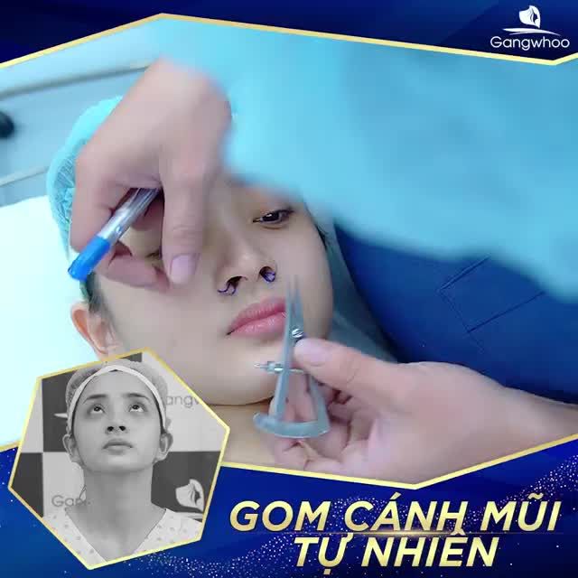 THU GỌN CÁNH MŨI - GIẢI PHÁP HOÀN HẢO CHO CÁC CÔ NÀNG CÓ MŨI TO BÈ