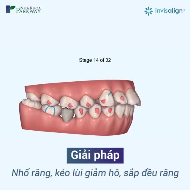 TÌM LẠI SỰ TỰ TIN TRONG GIAO TIẾP VỚI NIỀNG RĂNG INVISALIGN