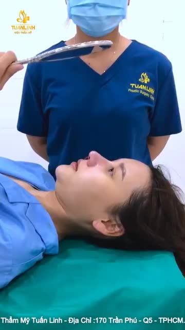 TRƯỚC và SAU Nâng mũi cấu trúc bọc Megaderm khác nhau như thế nào???