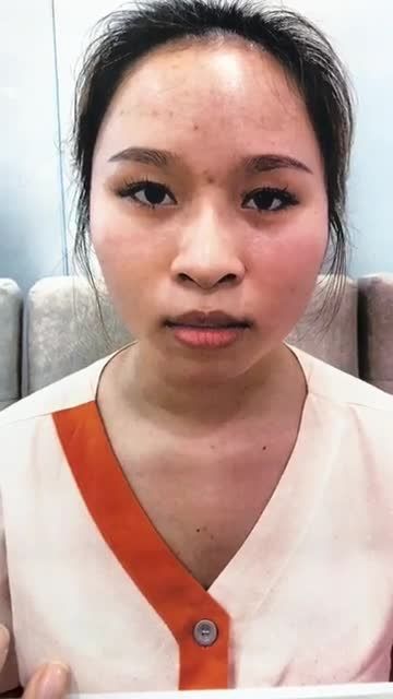 Vì sao nâng mũi nhân tạo thường không bền?