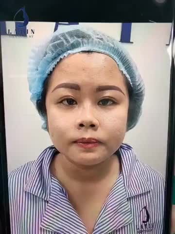 KHẮC PHỤC MŨI NGẮN, ĐẦU MŨI TO, HẾCH SAU 1H30'