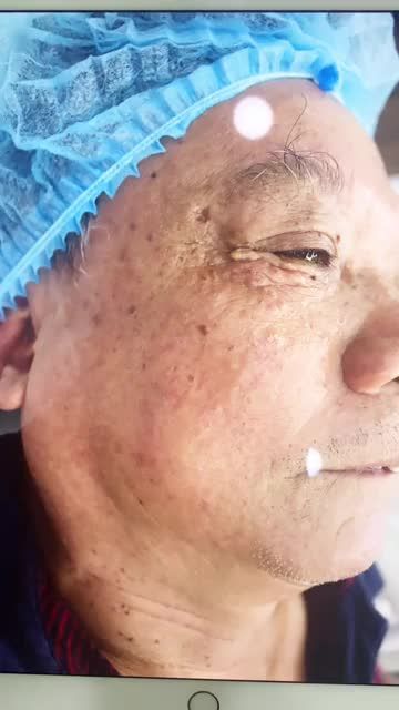 XÓA SỔ MỤN THỊT " Sạch" ngay sau 40 phút