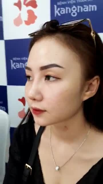 Khách nâng mũi sau 10 ngày cắt chỉ với dịch vụ Mũi Sline 4D nanoform chỉnh xương
