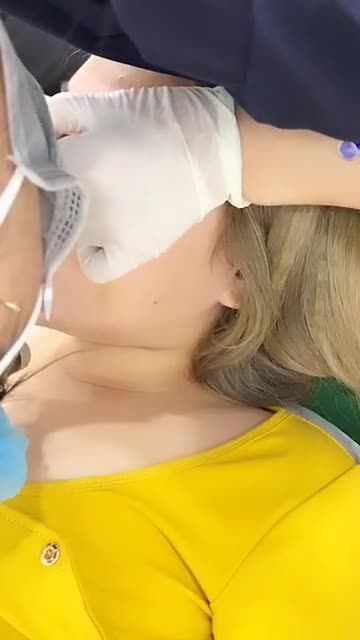 Dáng mũi cấu trúc tái khám sau 10 ngày