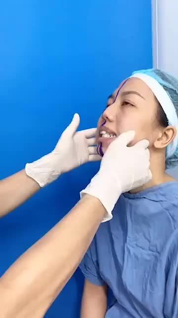 Giải mã giải pháp cho khuyết điểm MẶT LỆCH với công nghệ AI-FACE