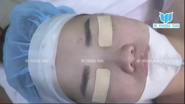 Cận cảnh một ca nâng mũi sụn sườn Surgiform tại bệnh viện