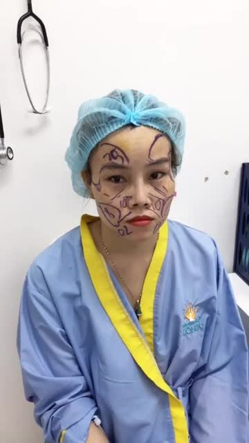 Giải cứu mặt gầy, hốc gác Bằng cấy mỡ mặt Biogen số 1 Nhật bản Tại bệnh viện thẩm Mỹ Đông Á
