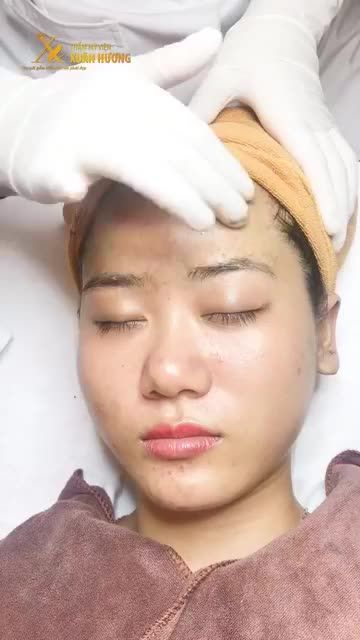MỤN NHIỀU CỠ NÀO, THÂM MỤN BAO NHIÊU CŨNG BỊ ĐẨY LÙI SAU KHI CẤY KHOÁNG SINH HỌC THẢO DƯỢC