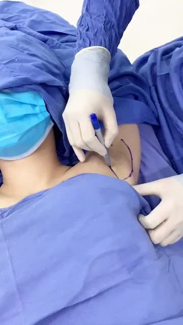 Quy trình hút tuyến khử mùi hôi nách cho khách hàng