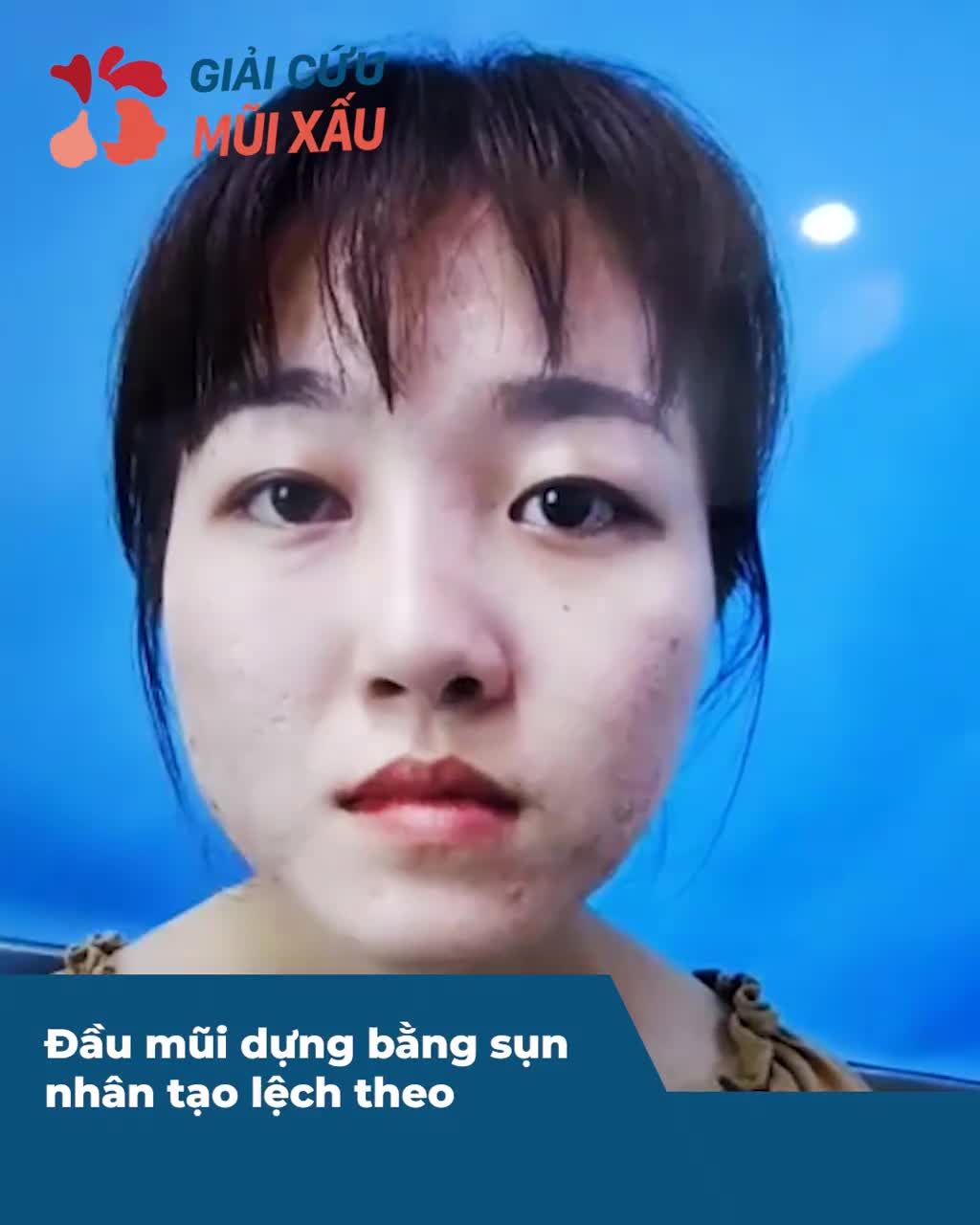 GIẢI CỨU MŨI LỆCH - Sửa đúng chỗ - Kết quả bất ngờ