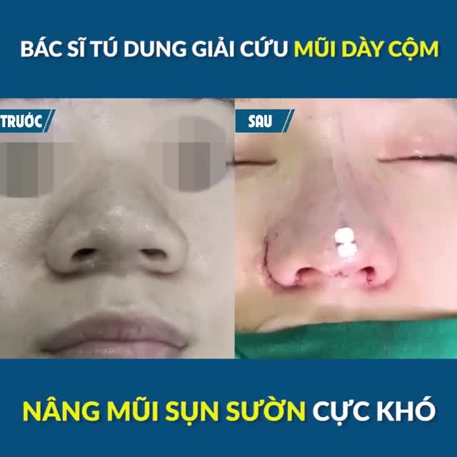 Bác sĩ Tú Dung TRÌNH LÀNG mũi sụn sườn ĐẸP NHỨC NHỐI