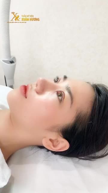 KHUÔN MẮT CỰC ƯNG Ý SAU 5 NGÀY CẮT MÍ + MỞ GÓC MẮT TẠI TMV XUÂN HƯƠNG