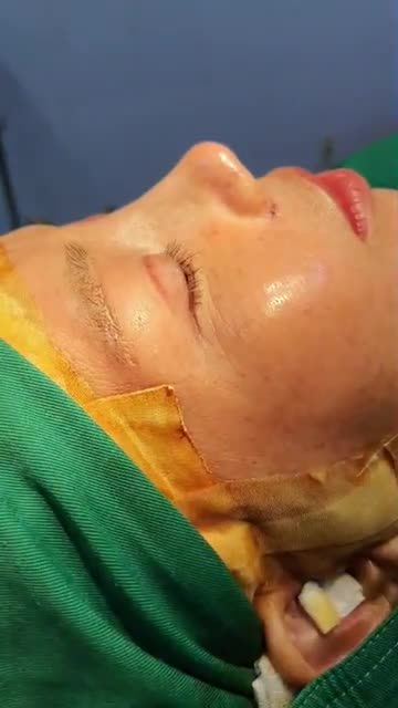 SIÊU PHẨM TẠI BS KỲ Y DƯỢC NÂNG MŨI BÁN CẤU TRÚC SỤN TAI ĐA LỚP VÀ CUỘN CÁNH MŨI PLASMA