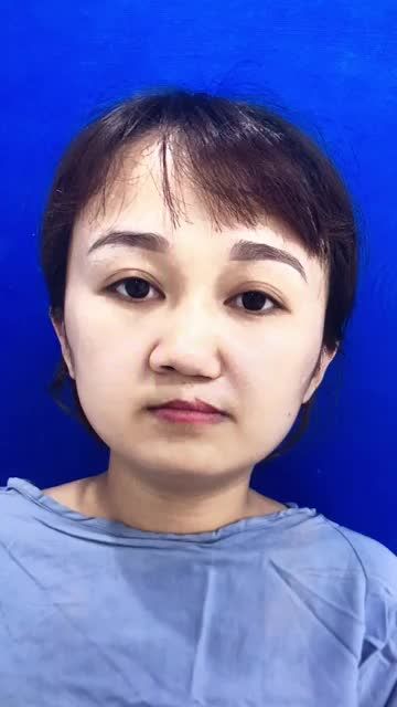 Cô gái thay đổi thần thái 180 độ sau khi nâng mũi SỤN SƯỜN - SỬA SẸO MÔI  tại BVTM KANGNAM