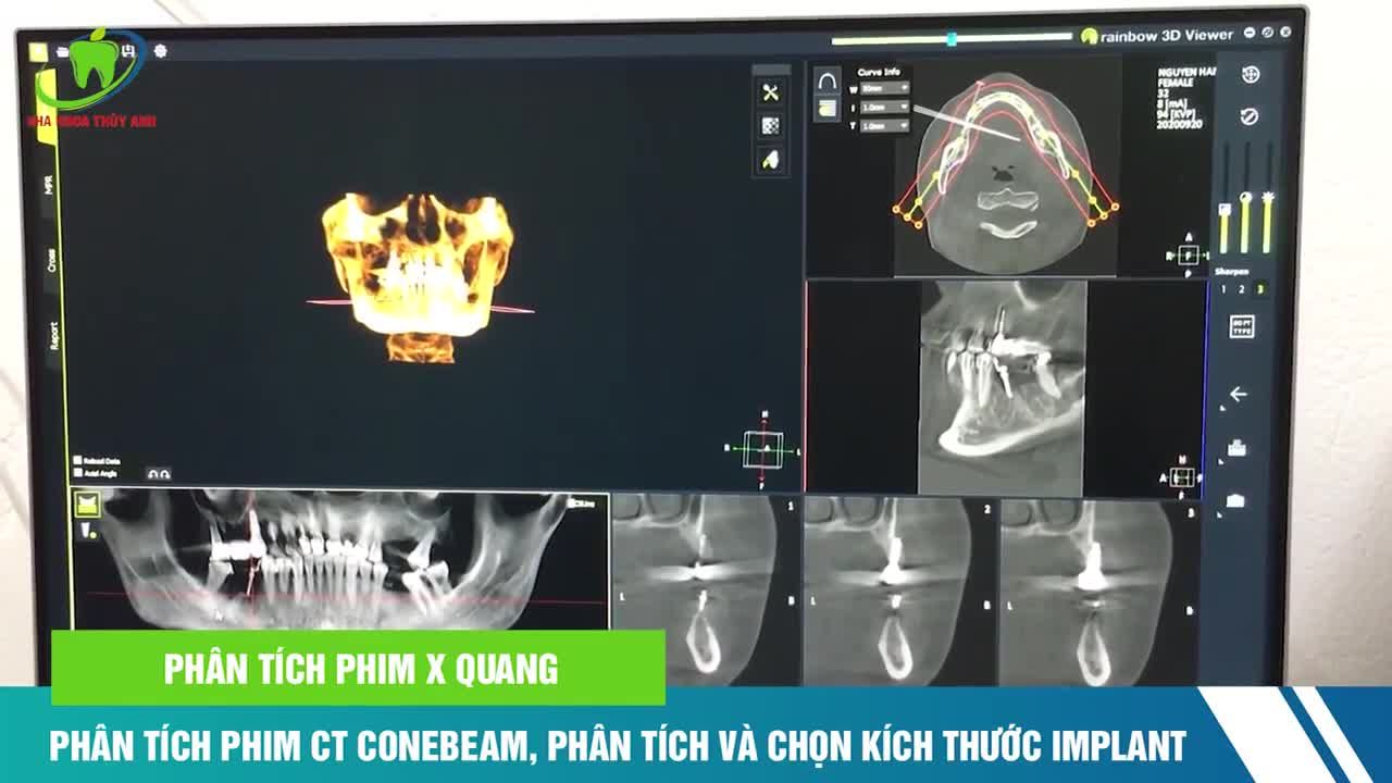 THỦ THUẬT BỔ SUNG KHI CẤY 2 IMPLANT RĂNG HÀM TRONG TRƯỜNG HỢP TIÊU XƯƠNG NHIỀU.