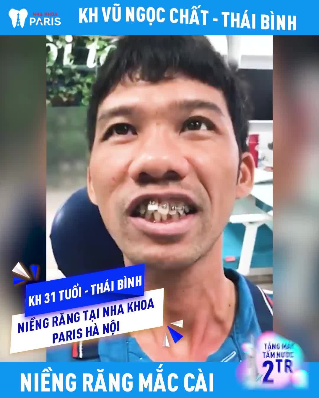 31 Tuổi Niềng Răng Chưa Phải Là Muộn