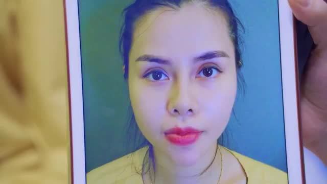 GIẢI CỨU thành công ca mí lỗi hỏng 4 lần do phẫu thuật mí tại cơ sở không uy tín - Mời quý khách hàng cùng theo dõi